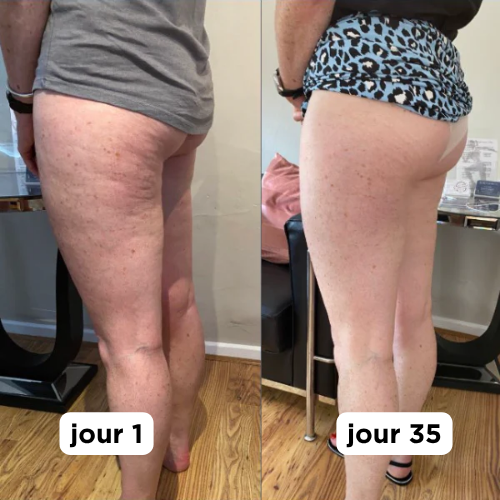 Masseur Anti-cellulite Vibrazen