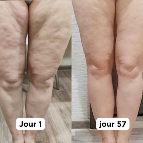 Masseur Anti-cellulite Vibrazen