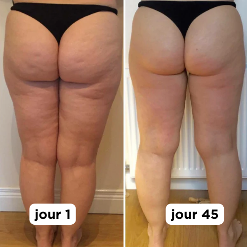 Masseur Anti-cellulite Vibrazen